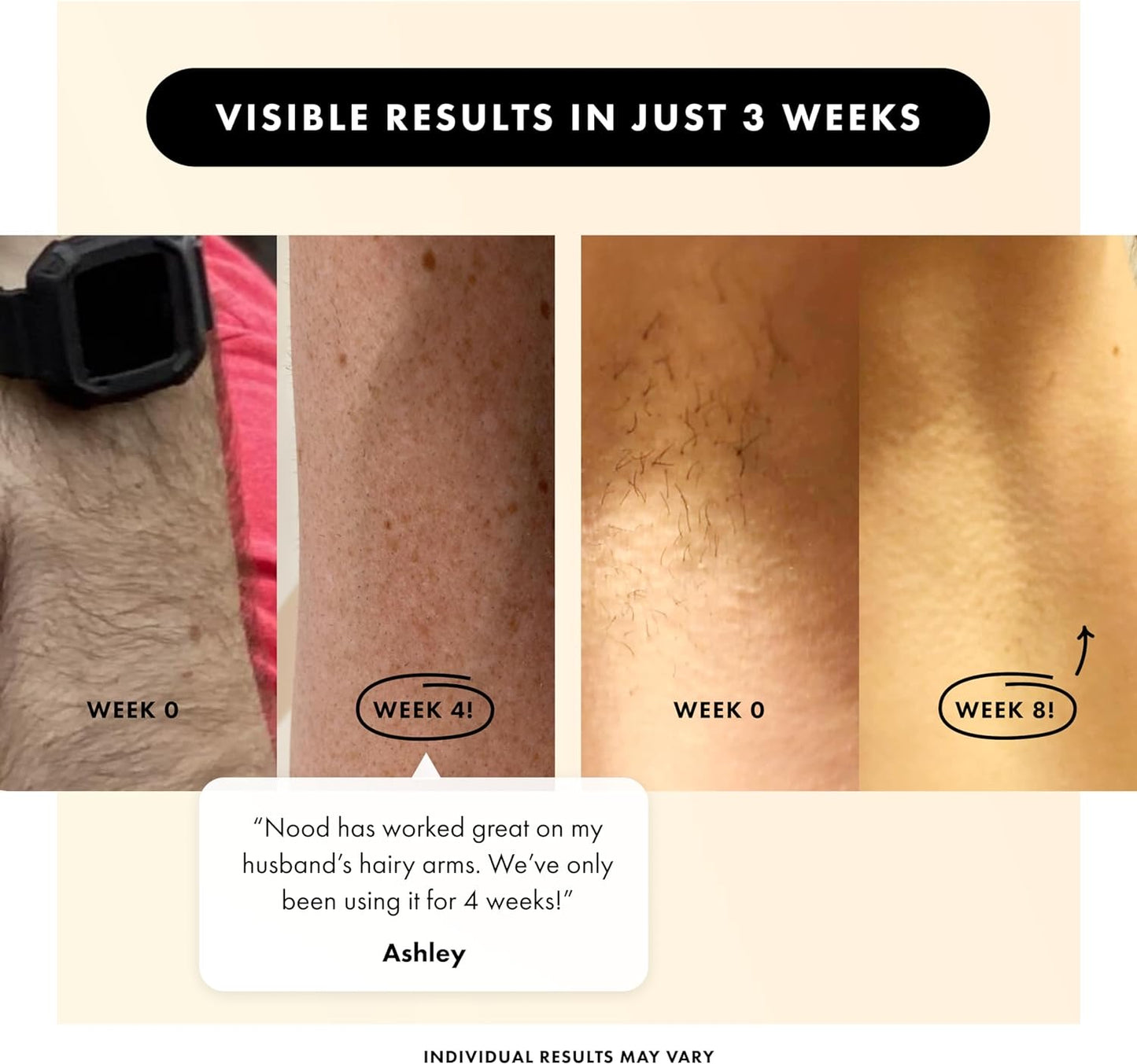 Flasher 2.0 by Nood, IPL Laser Hair Removal Device for Men and Women, Pain-free and Permanent Results, Safe for Whole Body Treatment